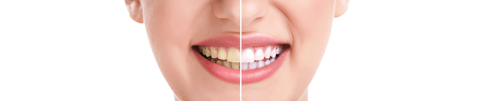 Teeth Whitening in Humble, Texas